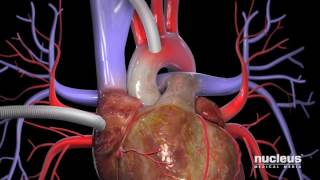 Coronary Artery Bypass Graft  Understanding Cardiovascular Disease [upl. by Grefer]