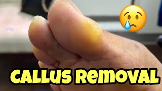 EXTREMELY SATISFYING CALLUS REMOVAL FROM THE FOOT [upl. by Rimhsak]