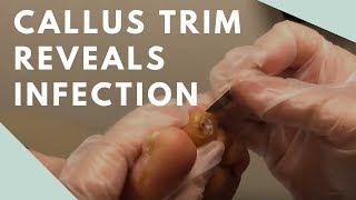 Callus Trim Reveals Infection [upl. by Oznol]