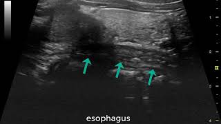 Impedance of the esophagus  Jeffrey L Conklin MD  UCLA [upl. by Guido]