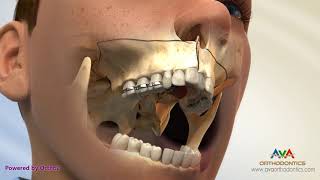 Surgical Orthodontic Treatment for Constricted Upper Jaw  SARPE [upl. by Bores]