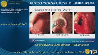 Gastric Bypass Complications I  Obstructions [upl. by Cornell]