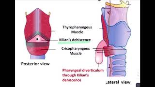 ESOPHAGEAL DIVERTICULUM [upl. by Airotciv]