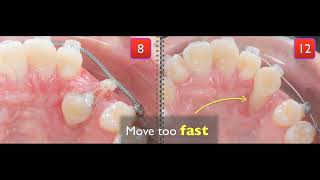 Treatment of palatal impaction [upl. by Alexandra]