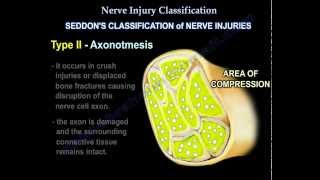 Nerve Injury types  Nerve recovery  Everything You Need To Know  Dr Nabil Ebraheim [upl. by Ferne]