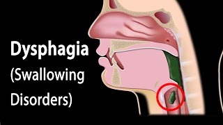 Dysphagia Animation [upl. by Esmeralda703]