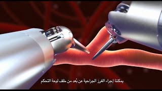 Totally Endoscopic Robotic Coronary Bypass TECAB [upl. by Nightingale]